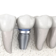 Image of dental implant