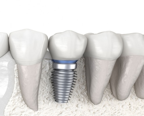 Image of dental implant