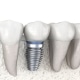 Image of dental implant